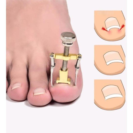 Batık Tırnak Çıkarma Aparatı