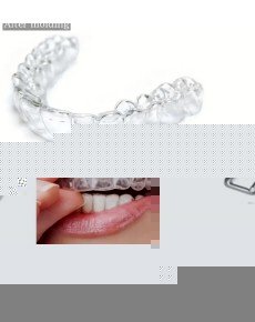 515 Bruxism Night Apparatus (Night Plate)